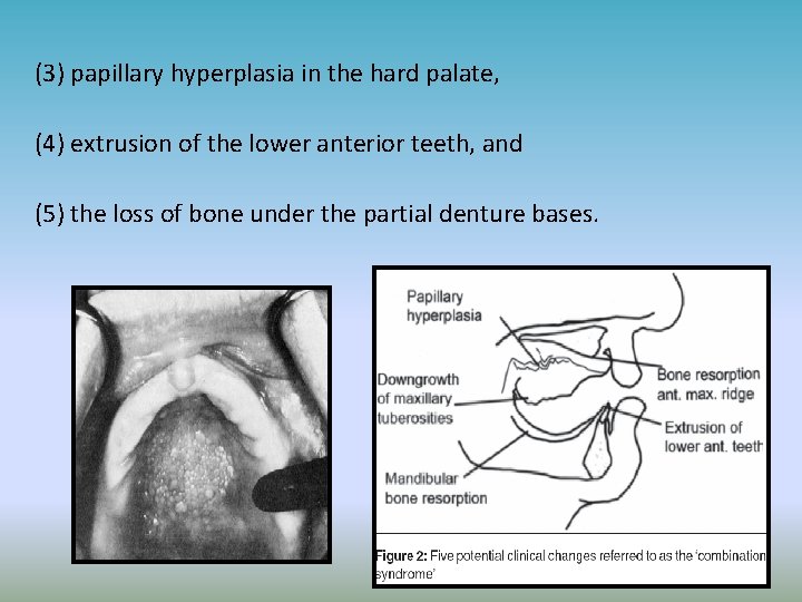 (3) papillary hyperplasia in the hard palate, (4) extrusion of the lower anterior teeth,