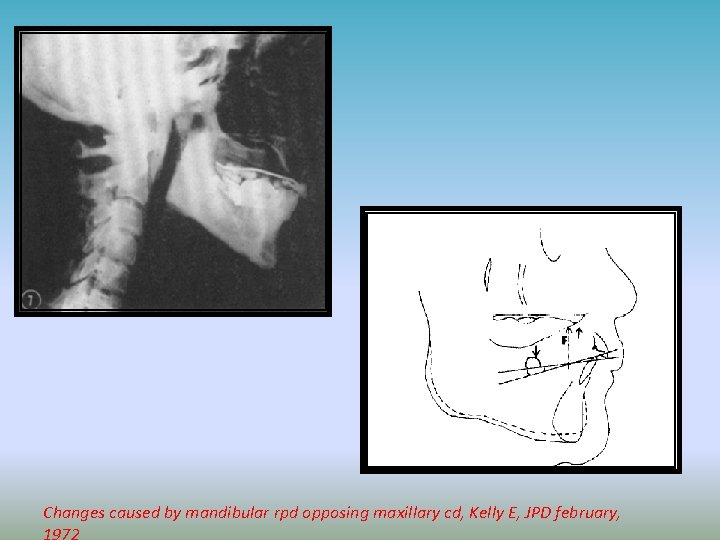 Changes caused by mandibular rpd opposing maxillary cd, Kelly E, JPD february, 