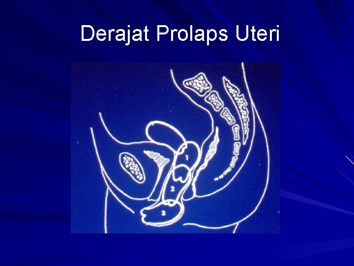 Derajat Prolaps Uteri 