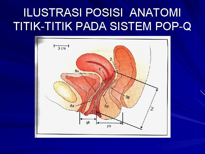ILUSTRASI POSISI ANATOMI TITIK-TITIK PADA SISTEM POP-Q 