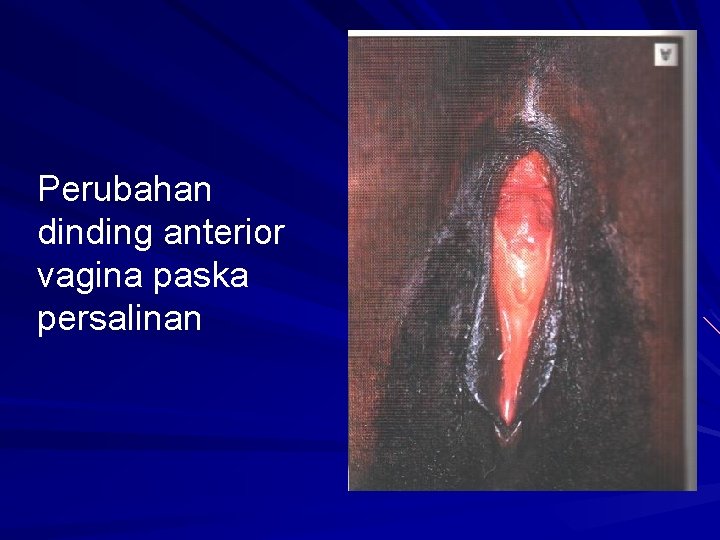 Perubahan dinding anterior vagina paska persalinan 