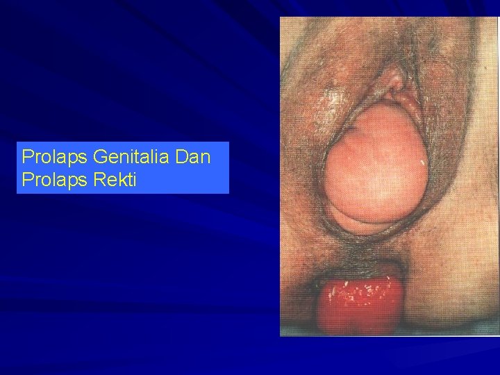 Prolaps Genitalia Dan Prolaps Rekti 
