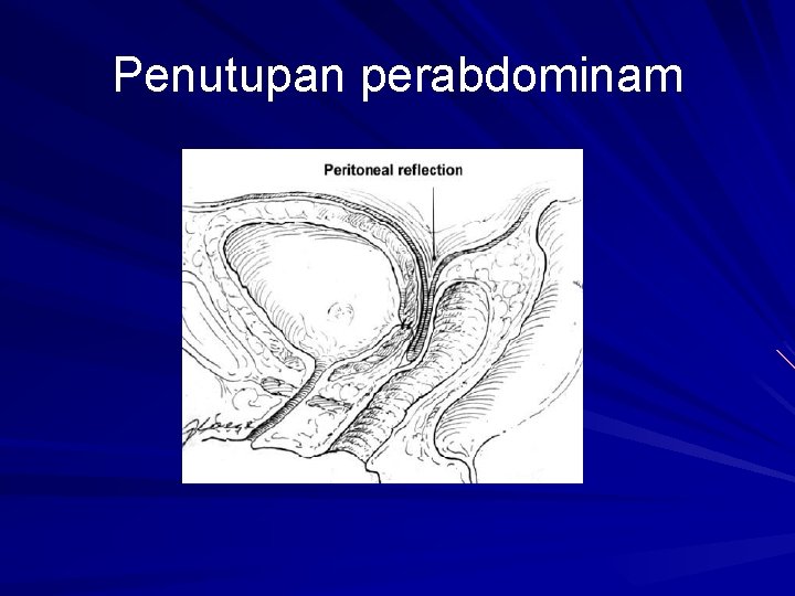 Penutupan perabdominam 