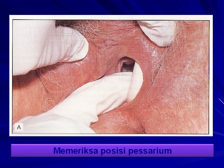 Memeriksa posisi pessarium 
