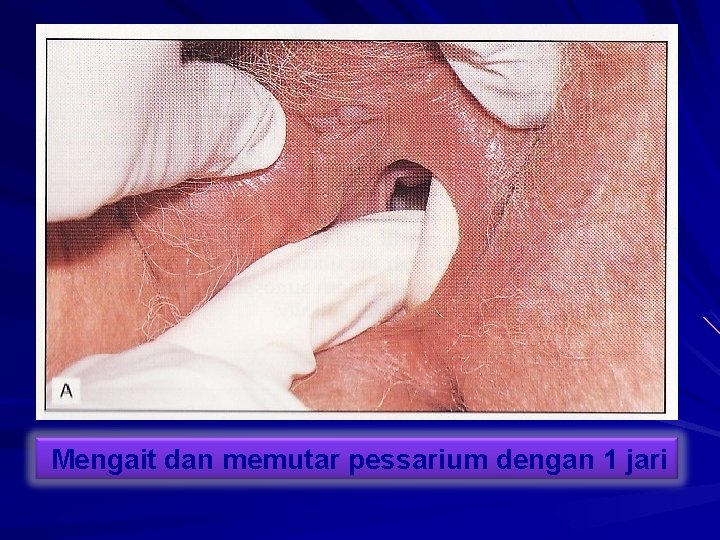 Mengait dan memutar pessarium dengan 1 jari 