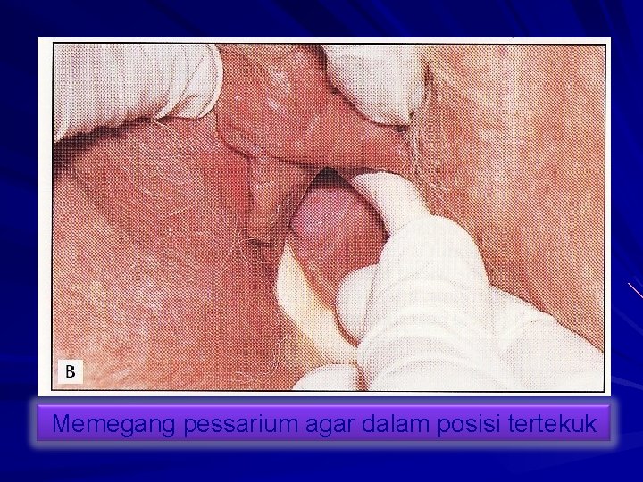 Memegang pessarium agar dalam posisi tertekuk 