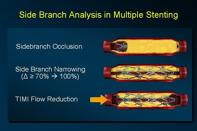 Side Branch Analysis in Multiple Stenting Sidebranch Occlusion Side Branch Narrowing (Δ ≥ 70%