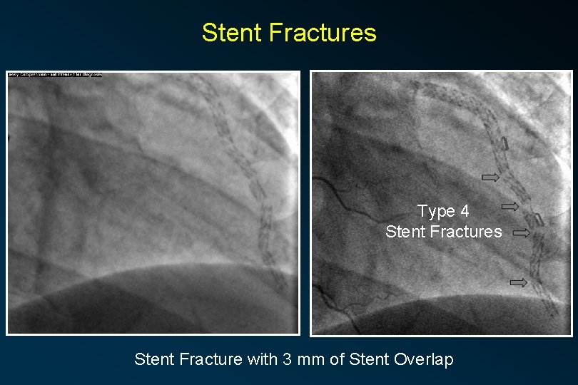 Stent Fractures Type 4 Stent Fractures Stent Fracture with 3 mm of Stent Overlap