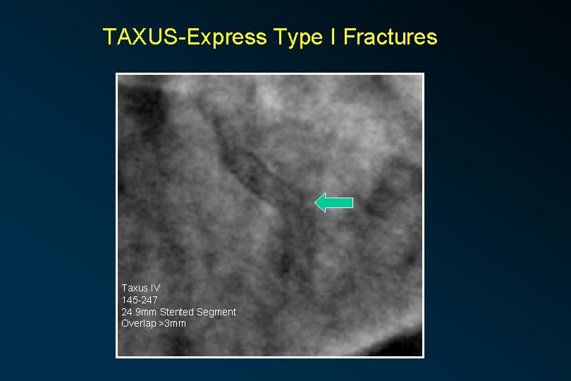 TAXUS-Express Type I Fractures Taxus IV 145 -247 24. 9 mm Stented Segment Overlap