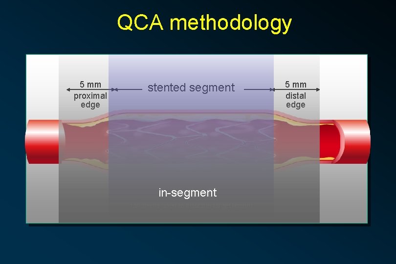QCA methodology 5 mm proximal edge stented segment in-stent (all stents used to treat