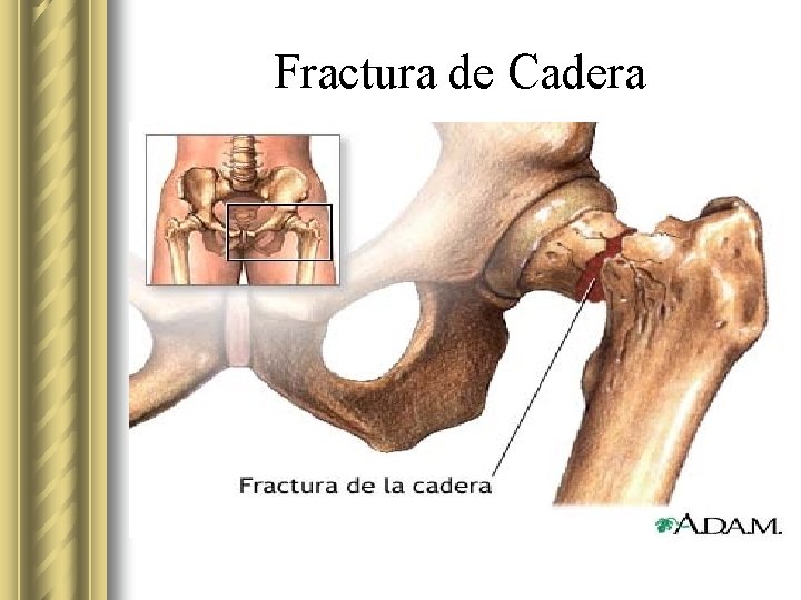 Fractura de Cadera 