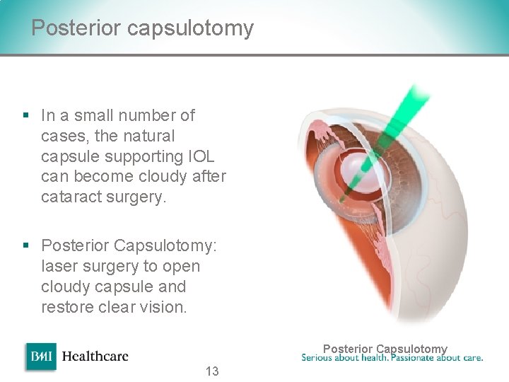 Posterior capsulotomy § In a small number of cases, the natural capsule supporting IOL Posterior capsulotomy § In a small number of cases, the natural capsule supporting IOL