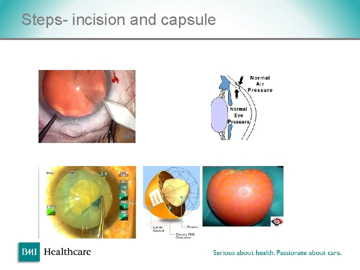 Steps- incision and capsule v Steps- incision and capsule v