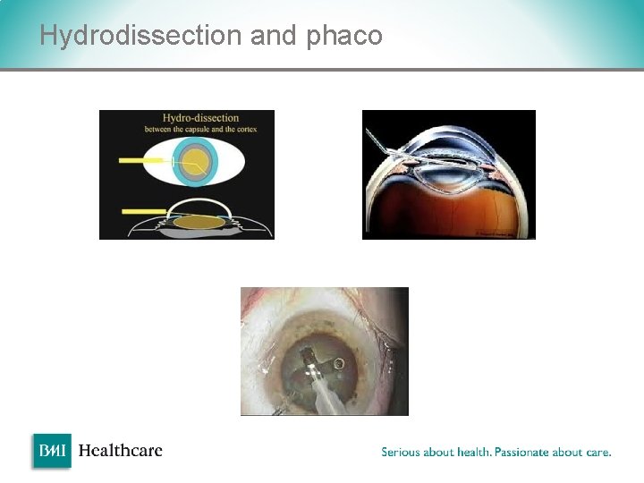 Hydrodissection and phaco v Hydrodissection and phaco v