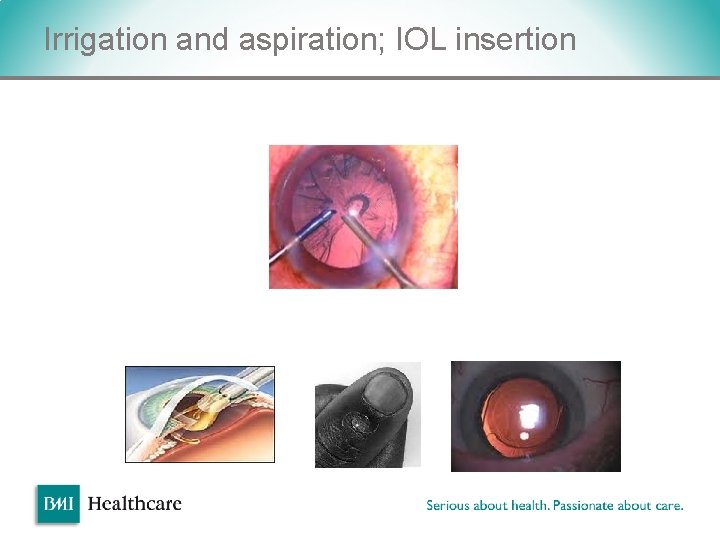 Irrigation and aspiration; IOL insertion v Irrigation and aspiration; IOL insertion v