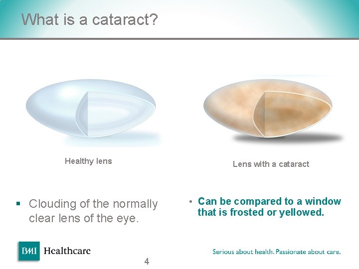 What is a cataract? v Healthy lens Lens with a cataract § Clouding of What is a cataract? v Healthy lens Lens with a cataract § Clouding of