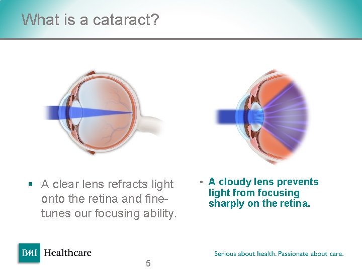 What is a cataract? v § A clear lens refracts light onto the retina What is a cataract? v § A clear lens refracts light onto the retina