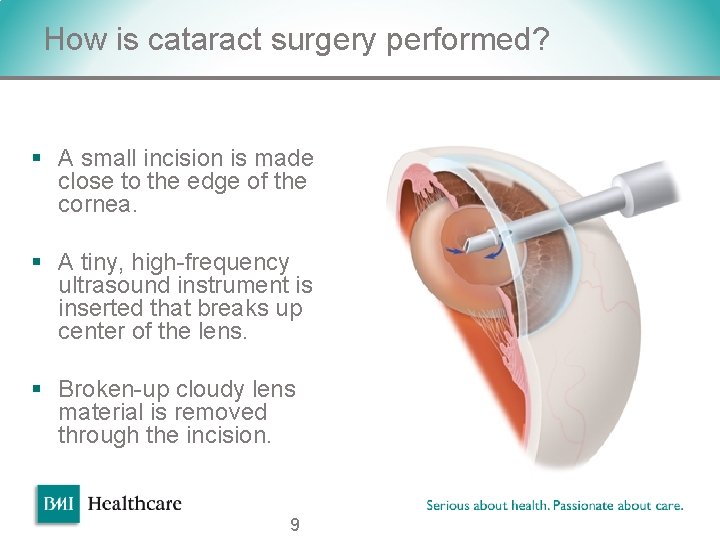 How is cataract surgery performed? § A small incision is made close to the How is cataract surgery performed? § A small incision is made close to the