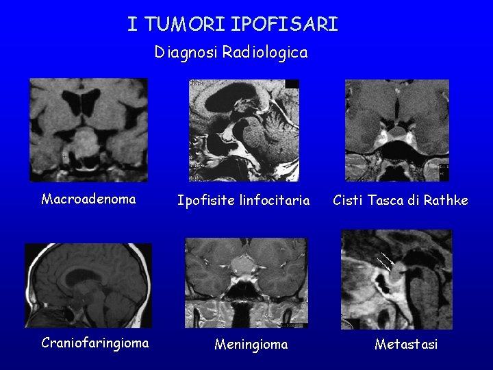 I TUMORI IPOFISARI Diagnosi Radiologica Macroadenoma Craniofaringioma Ipofisite linfocitaria Meningioma Cisti Tasca di Rathke