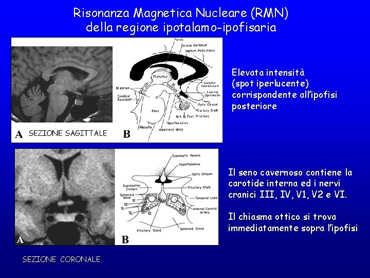 Risonanza Magnetica Nucleare (RMN) della regione ipotalamo-ipofisaria Elevata intensità (spot iperlucente) corrispondente all’ipofisi posteriore Risonanza Magnetica Nucleare (RMN) della regione ipotalamo-ipofisaria Elevata intensità (spot iperlucente) corrispondente all’ipofisi posteriore