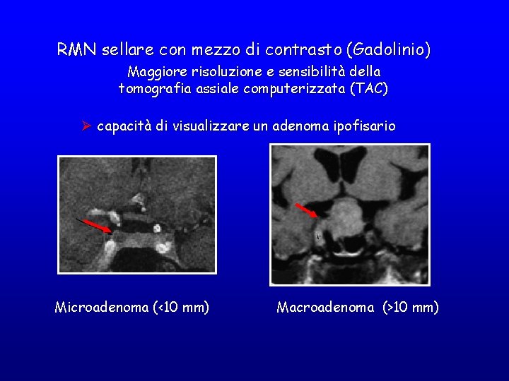 RMN sellare con mezzo di contrasto (Gadolinio) Maggiore risoluzione e sensibilità della tomografia assiale RMN sellare con mezzo di contrasto (Gadolinio) Maggiore risoluzione e sensibilità della tomografia assiale