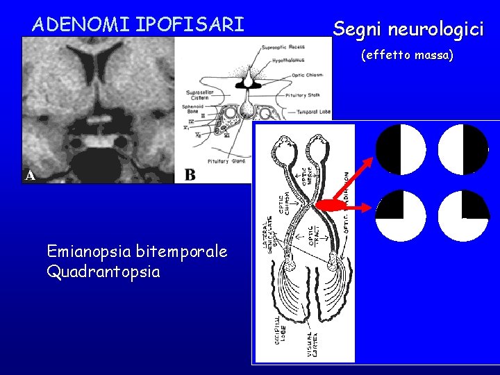 ADENOMI IPOFISARI Segni neurologici (effetto massa) Emianopsia bitemporale Quadrantopsia 