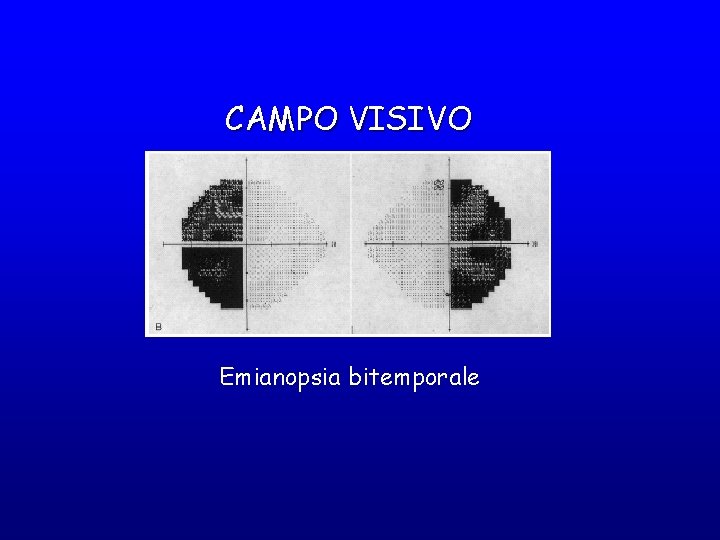 CAMPO VISIVO Emianopsia bitemporale 