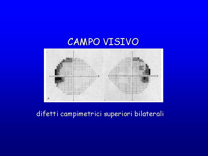 CAMPO VISIVO difetti campimetrici superiori bilaterali 