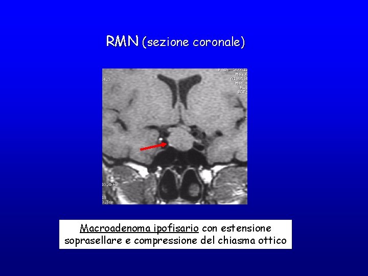 RMN (sezione coronale) Macroadenoma ipofisario con estensione soprasellare e compressione del chiasma ottico 