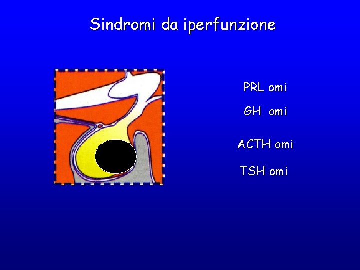 Sindromi da iperfunzione PRL omi GH omi ACTH omi TSH omi Sindromi da iperfunzione PRL omi GH omi ACTH omi TSH omi