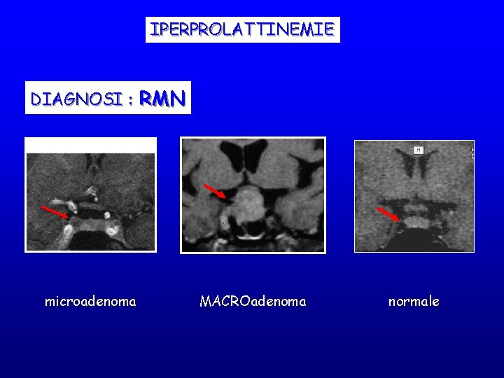 IPERPROLATTINEMIE DIAGNOSI : RMN microadenoma MACROadenoma normale IPERPROLATTINEMIE DIAGNOSI : RMN microadenoma MACROadenoma normale