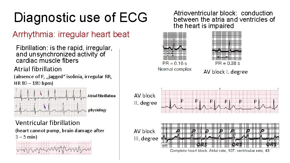 Diagnostic use of ECG Arrhythmia: irregular heart beat Atrioventricular block: conduction between the atria