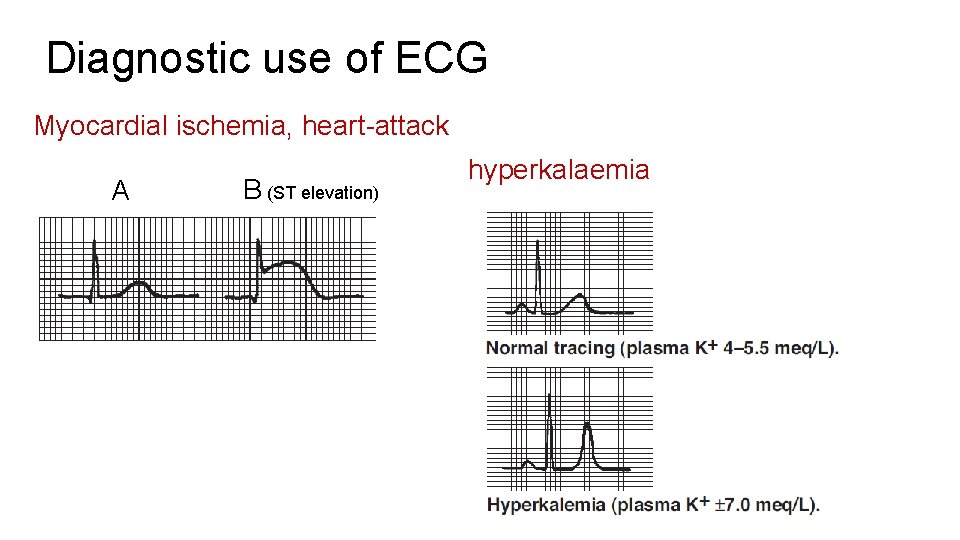 Diagnostic use of ECG Myocardial ischemia, heart-attack A B (ST elevation) hyperkalaemia 