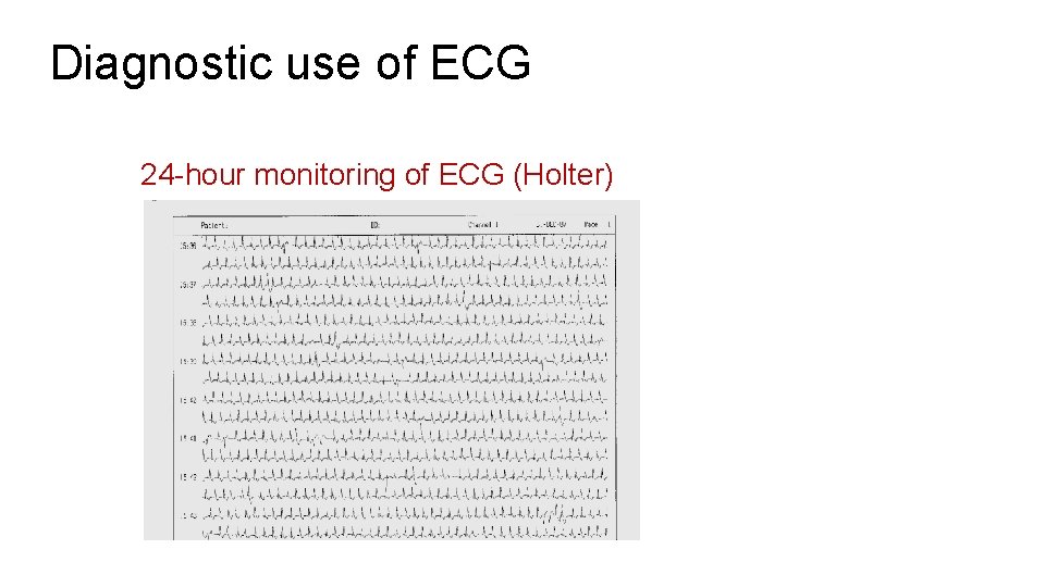 Diagnostic use of ECG 24 -hour monitoring of ECG (Holter) 