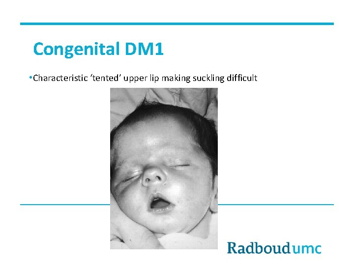 Congenital DM 1 • Characteristic ‘tented’ upper lip making suckling difficult 