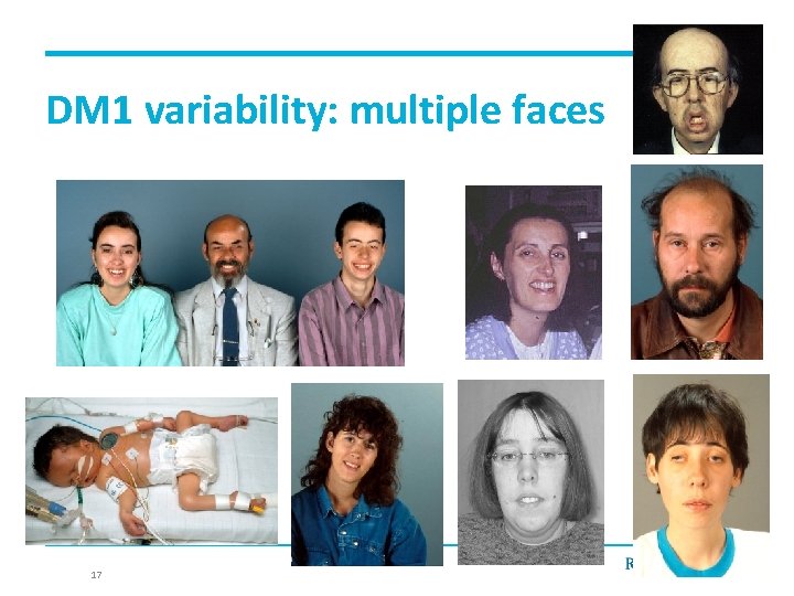 DM 1 variability: multiple faces 17 