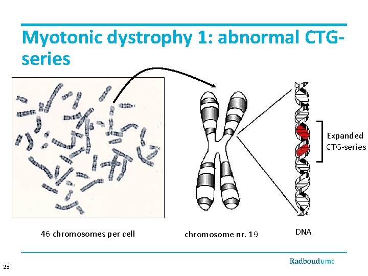 Myotonic dystrophy 1: abnormal CTGseries Expanded CTG-series 46 chromosomes per cell 23 chromosome nr.