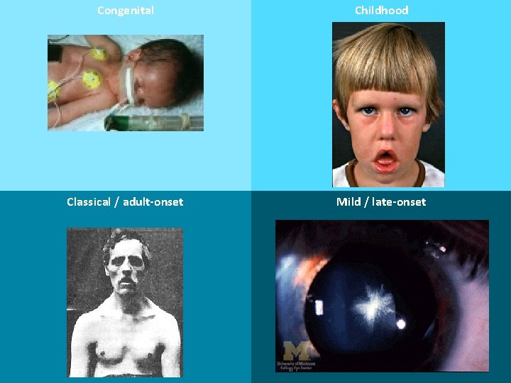 Congenital Childhood Neonaten Hypotonie en contracturen Respiratoire en slikproblemen IQ 40 -70 Mediane overleving