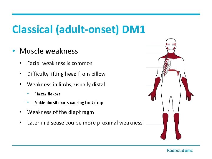 Classical (adult-onset) DM 1 • Muscle weakness • Facial weakness is common • Difficulty