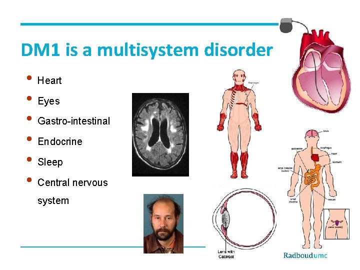 DM 1 is a multisystem disorder • Heart • Eyes • Gastro-intestinal • Endocrine