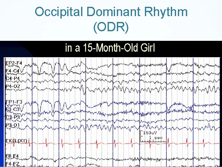 Occipital Dominant Rhythm (ODR) 