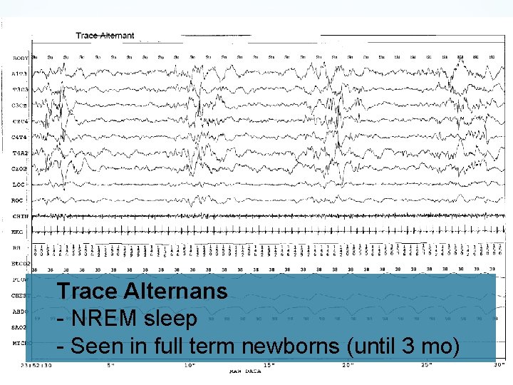 Trace Alternans - NREM sleep - Seen in full term newborns (until 3 mo)