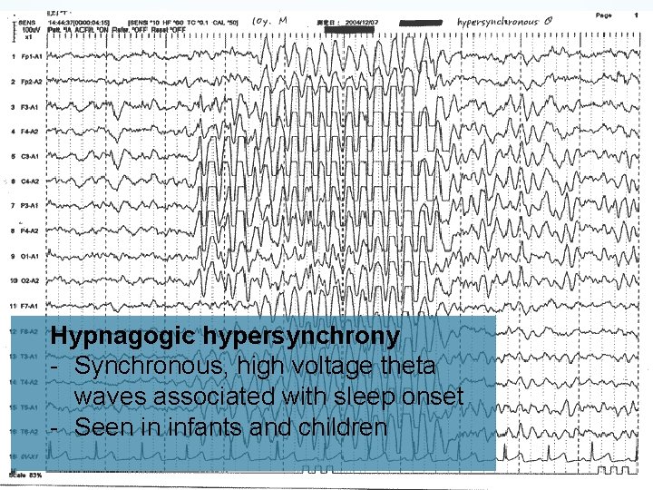 Hypnagogic hypersynchrony - Synchronous, high voltage theta waves associated with sleep onset - Seen