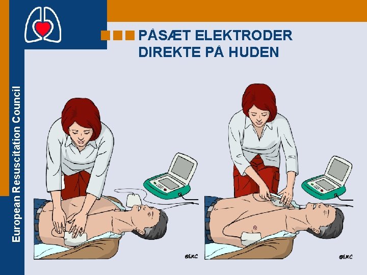 European Resuscitation Council PÅSÆT ELEKTRODER DIREKTE PÅ HUDEN 