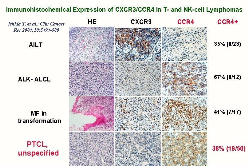 Immunohistochemical Expression of CXCR 3/CCR 4 in T- and NK-cell Lymphomas Ishida T, et