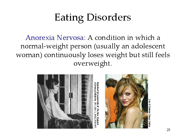 Eating Disorders Anorexia Nervosa: A condition in which a normal-weight person (usually an adolescent