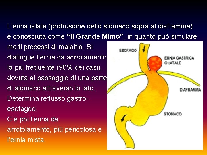 L’ernia iatale (protrusione dello stomaco sopra al diaframma) è conosciuta come “il Grande Mimo”,