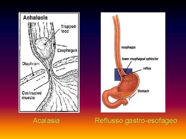 Acalasia Reflusso gastro-esofageo 