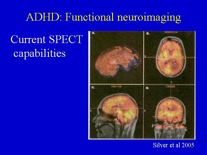 ADHD: Functional neuroimaging Current SPECT capabilities Silver et al 2005 