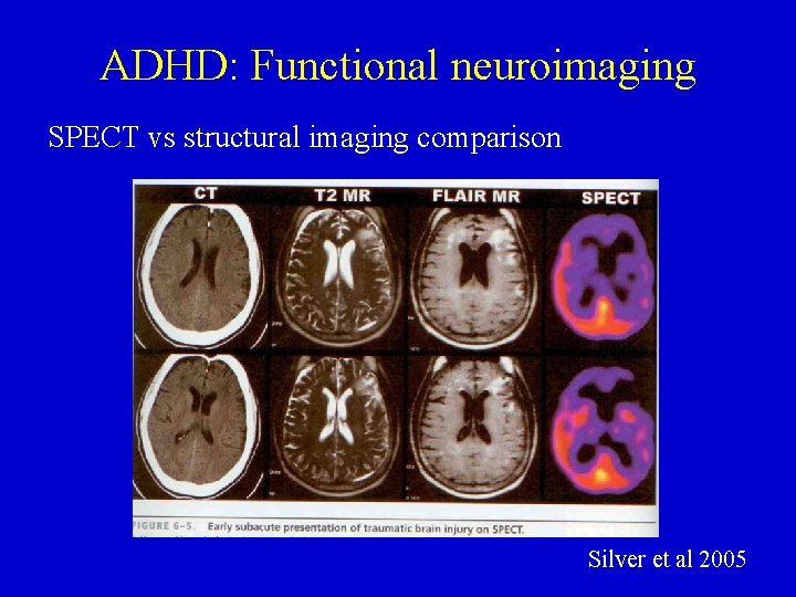 ADHD: Functional neuroimaging SPECT vs structural imaging comparison Silver et al 2005 